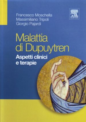 Malattia di Dupuytren